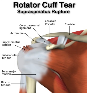 diagram of supraspinatus tendor tear in shoulder